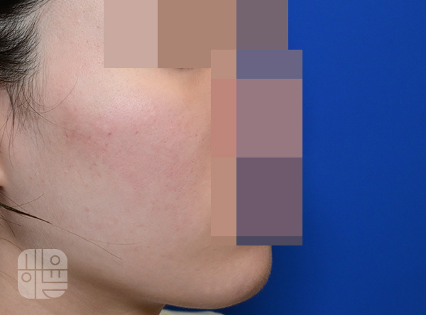[목동점] 얼굴화농성여드름 치료 후 사진 - 해율한의원